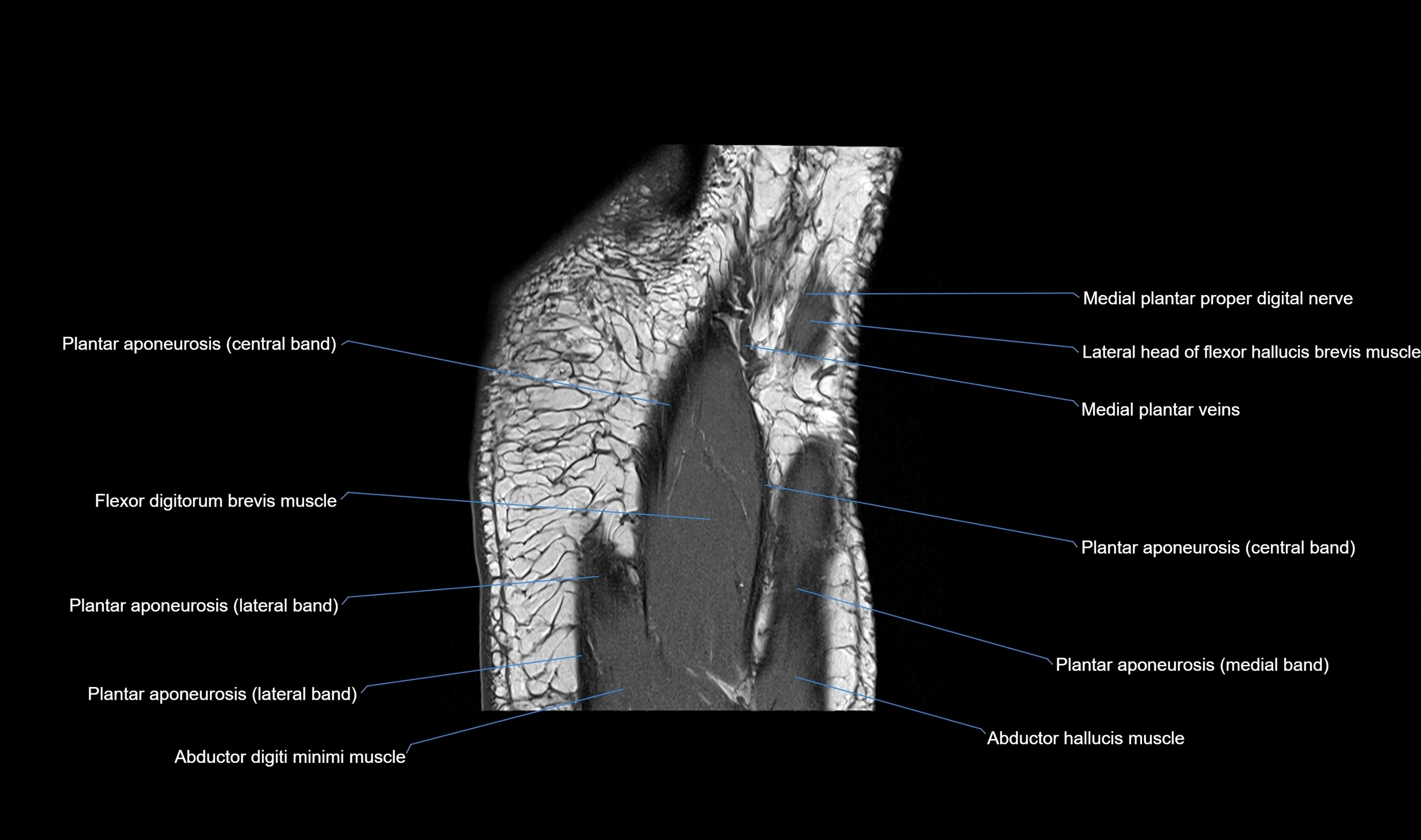 MRI mid foot coronal ligaments cross sectional anatomy 3T  radiology  image-img-00001-00037.webp